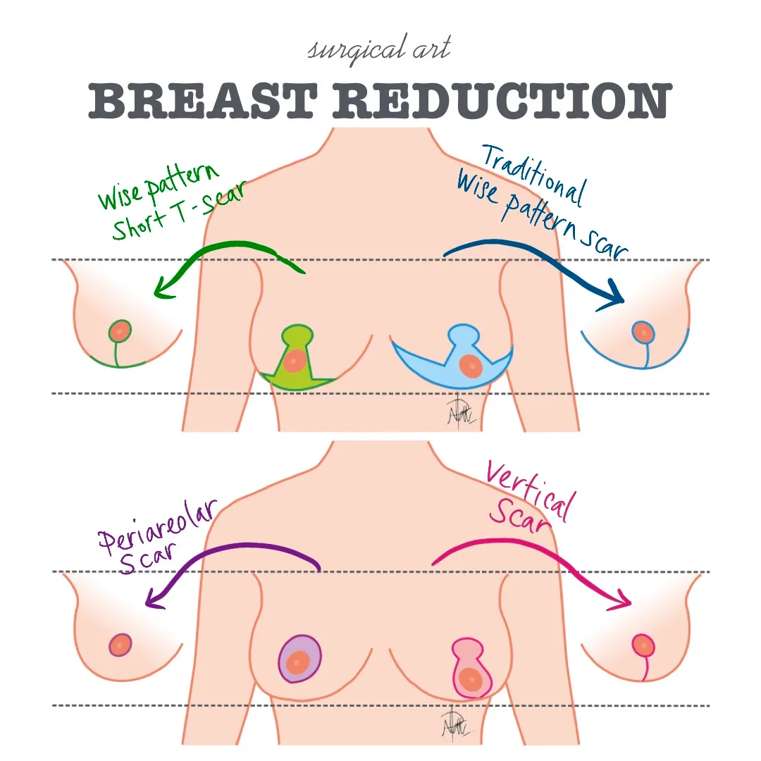 Surgical art illustration of breast reduction scar patterns
