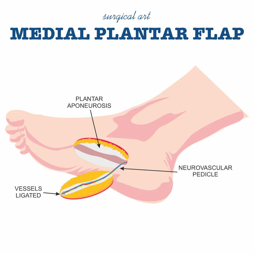 Surgical art illustration of the medial plantar flap technique