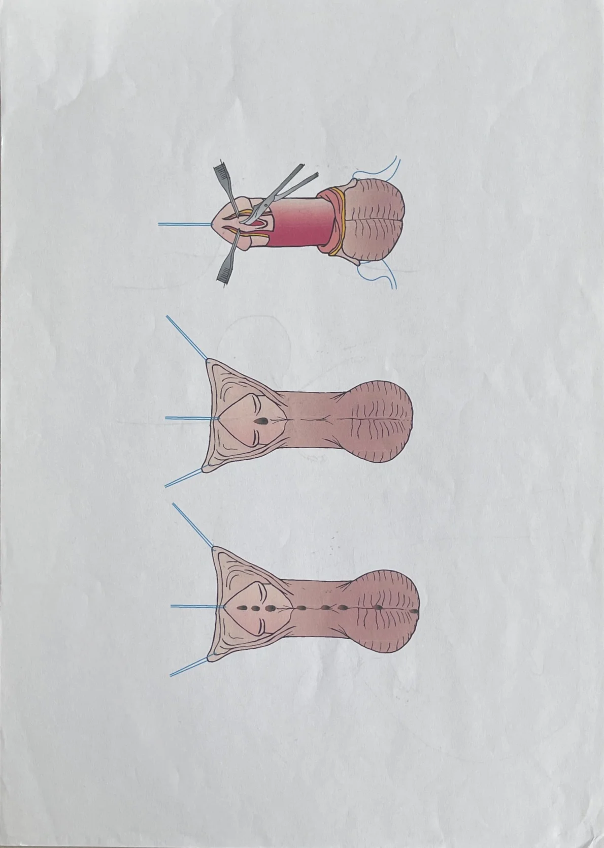 Illustrated surgical steps of a hypospadias repair procedure