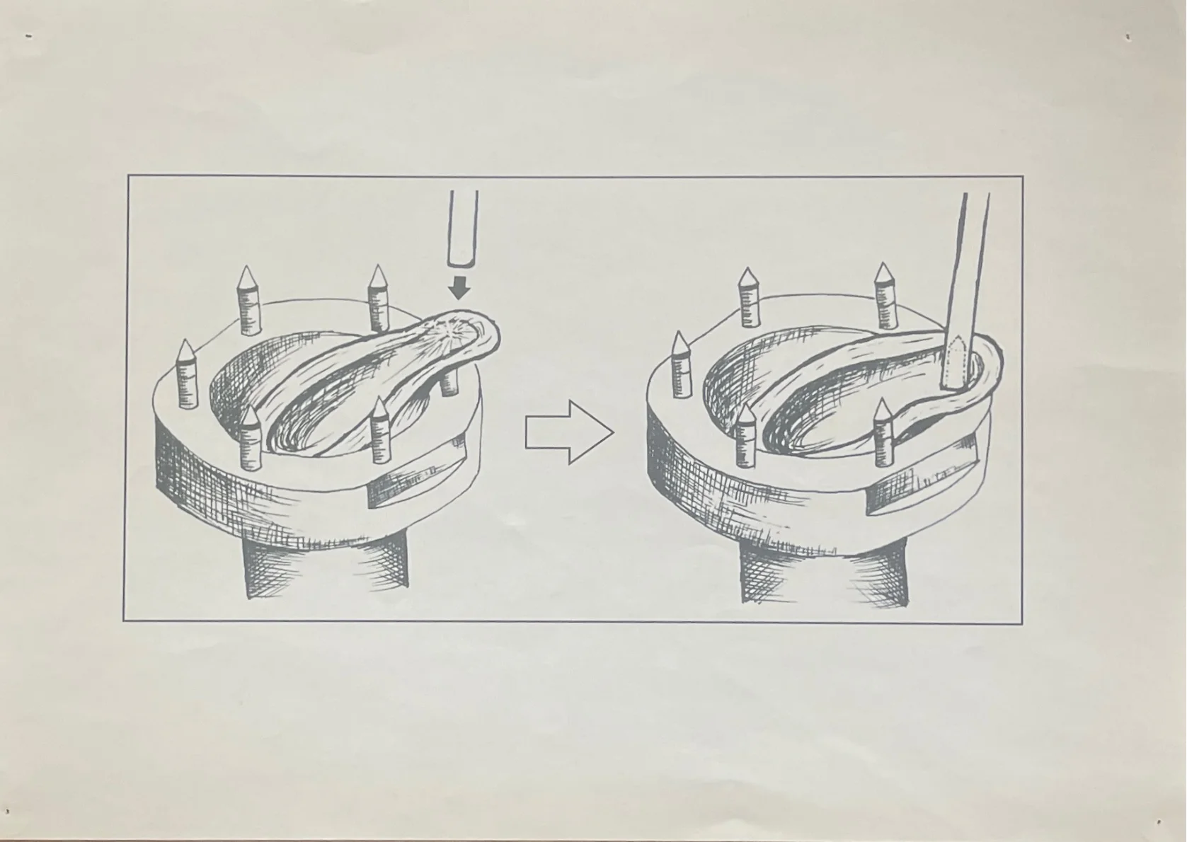 Hand-drawn diagram of urethral tube reconstruction for hypospadias repair
