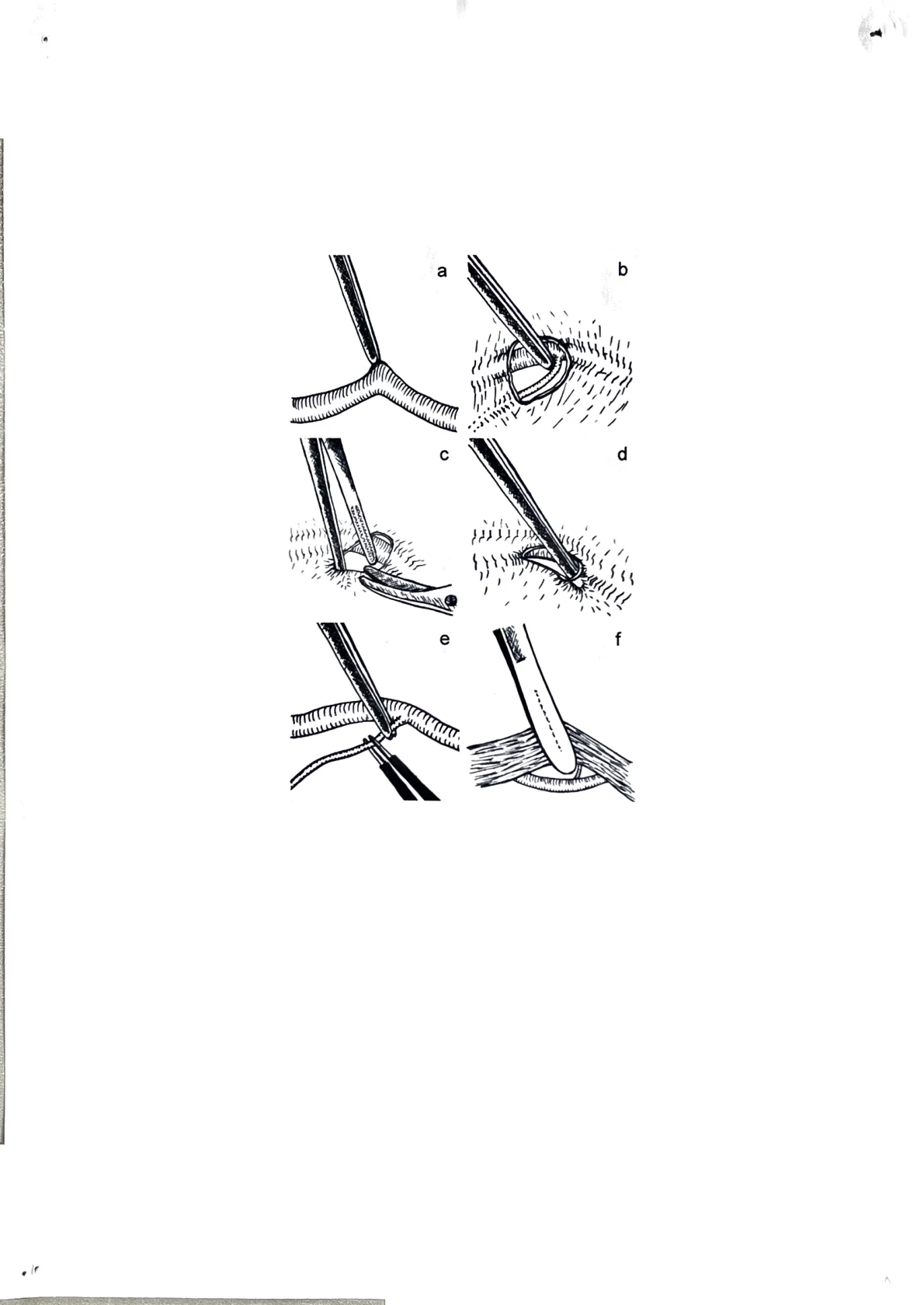 Step-by-step diagram of a subcuticular suture technique
